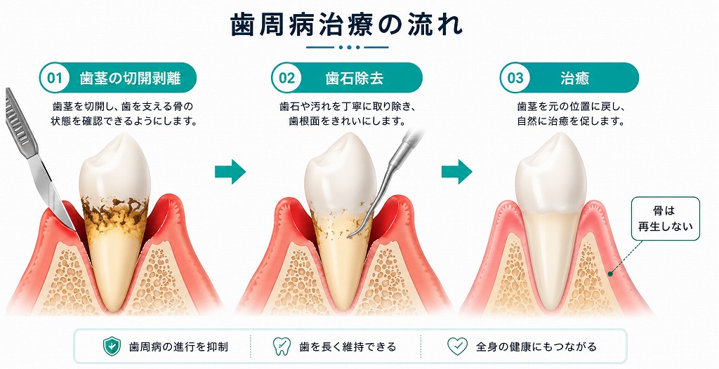 フラップ手術（歯肉剥離掻爬術）