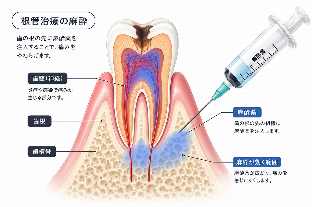 糖尿病患者の局所麻酔に関する注意点