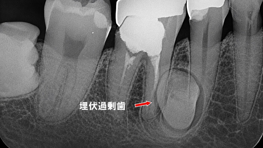 ６・５番部に認められる埋伏過剰歯のX線所見