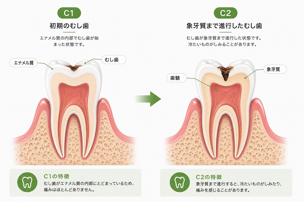 虫歯C1からC2への進行速度