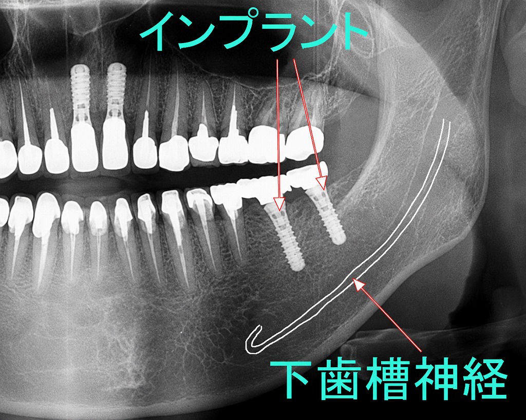 インプラント手術