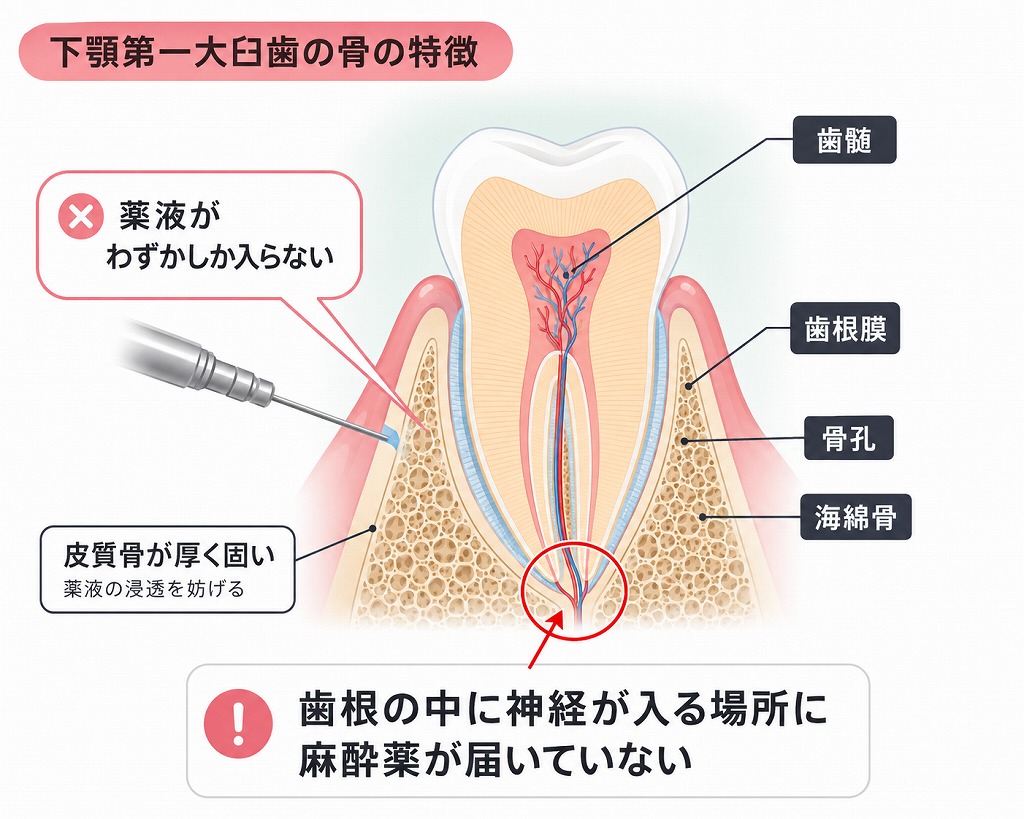 下顎第一大臼歯に麻酔が効かない理由