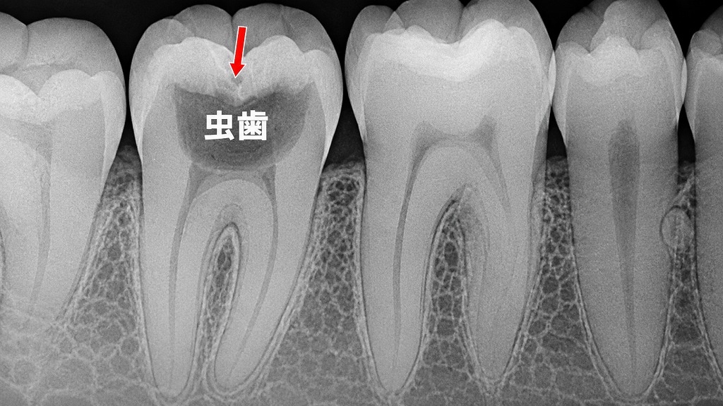 C2からC3へ進む虫歯の実態──表面に穴がなくても内部で急速拡大