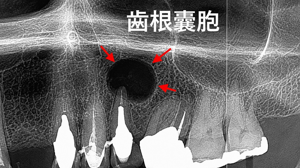上顎前歯（２番）が原因の大きい歯根嚢胞