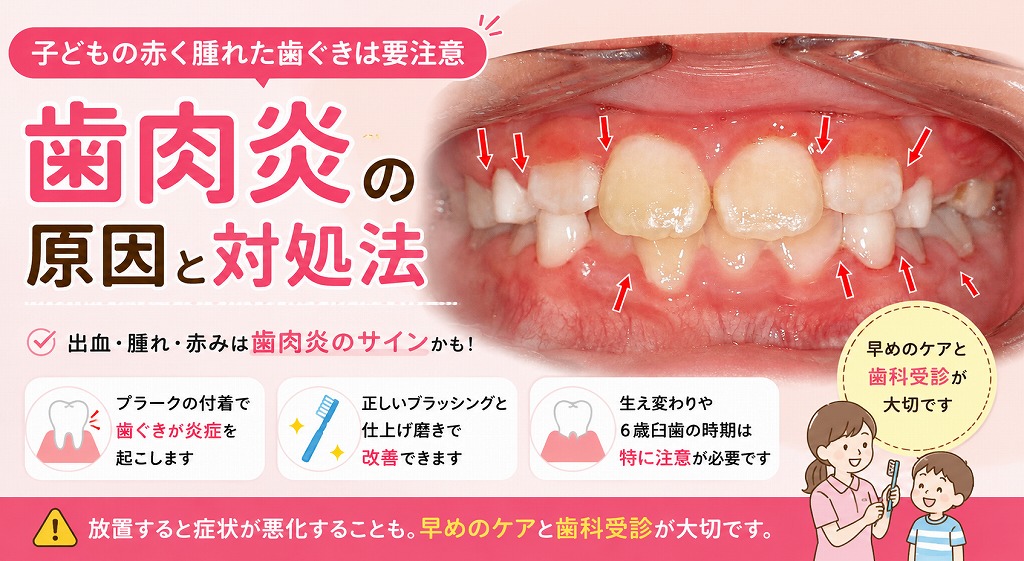 子どもの赤く腫れた歯ぐきは要注意｜歯肉炎の原因と対処法