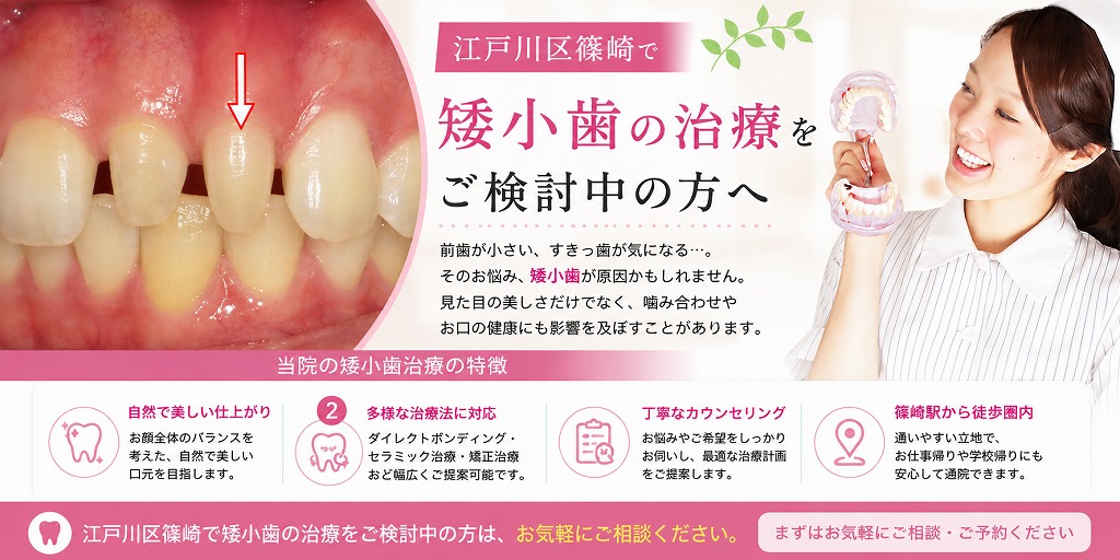江戸川区篠崎で矮小歯の治療をご検討中の方へ
