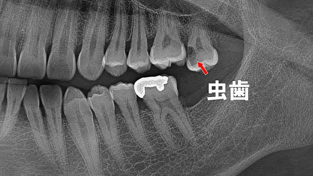 噛み合わせの乱れで生じる段差は要注意！辺縁隆線と虫歯の深い関係