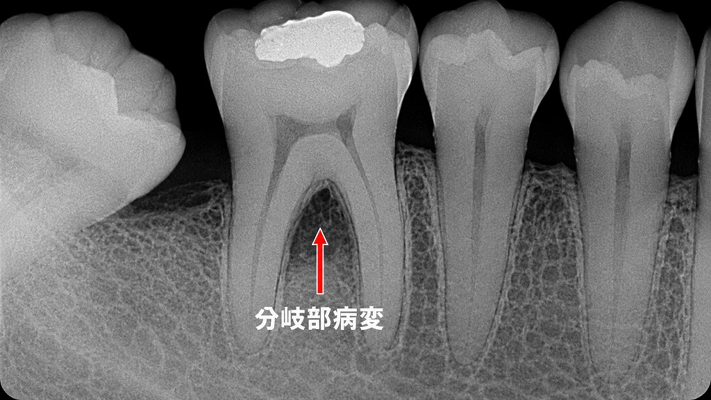 根分岐部Ⅲ度病変：再生療法（リグロス）が適応できない進行例