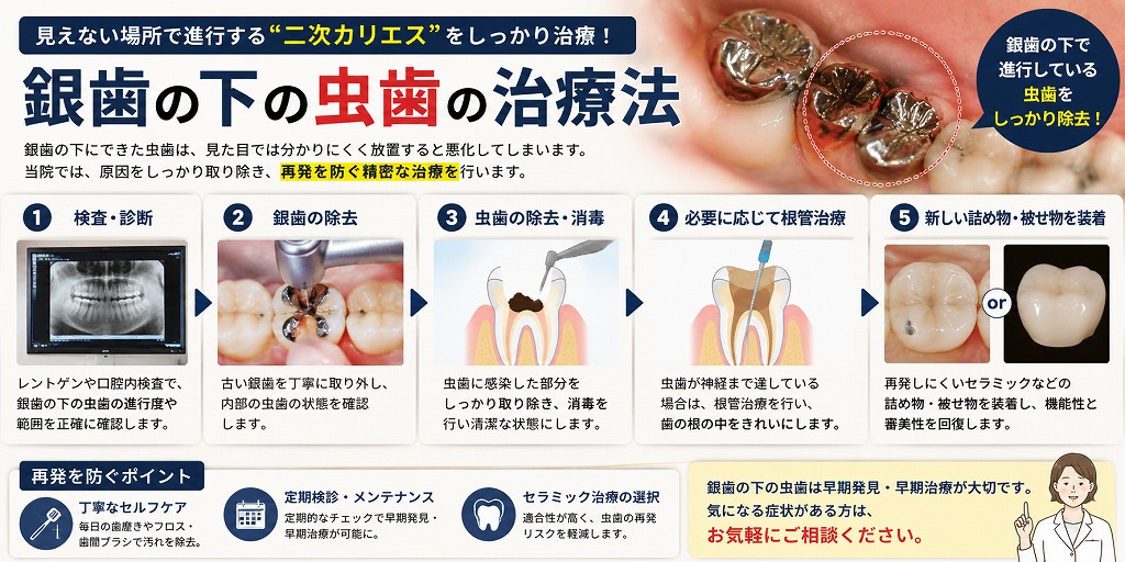 銀歯の下の虫歯の治療法