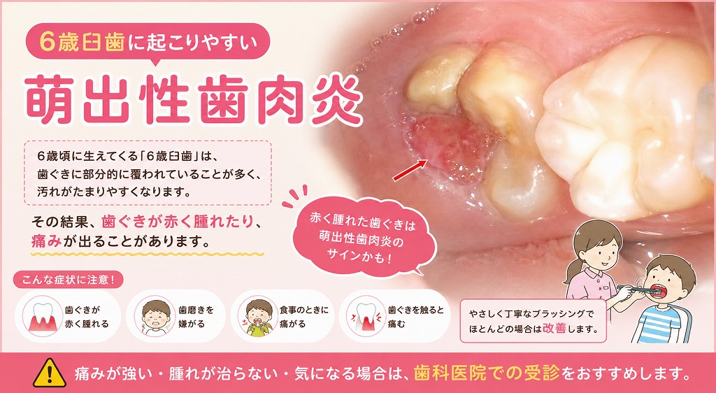 6歳臼歯に起こりやすい「萌出性歯肉炎」
