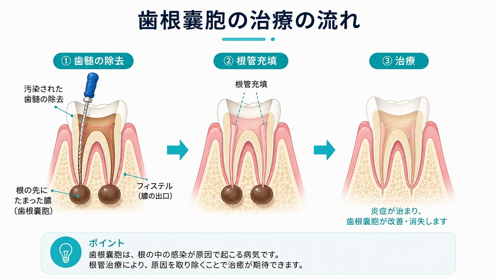 根管治療の流れ