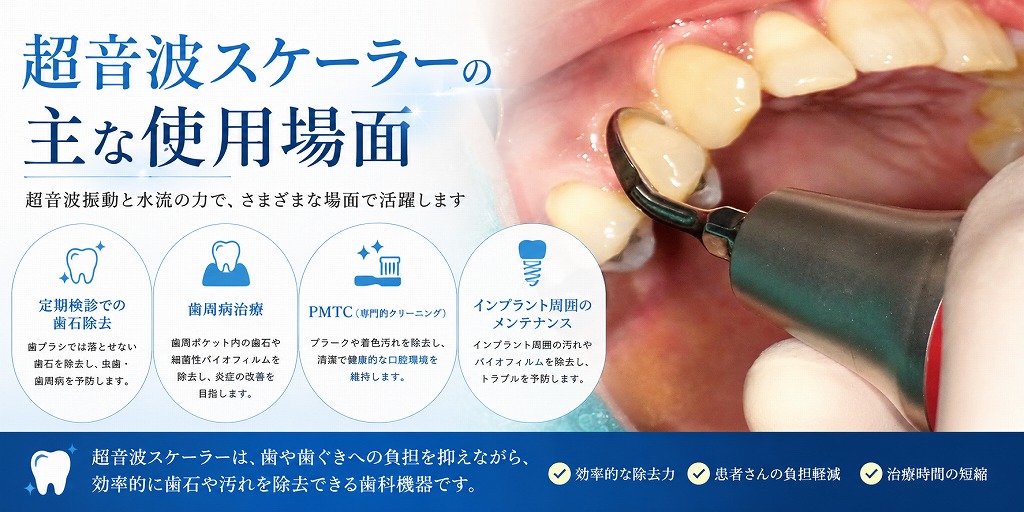 超音波スケーラーの主な使用場面