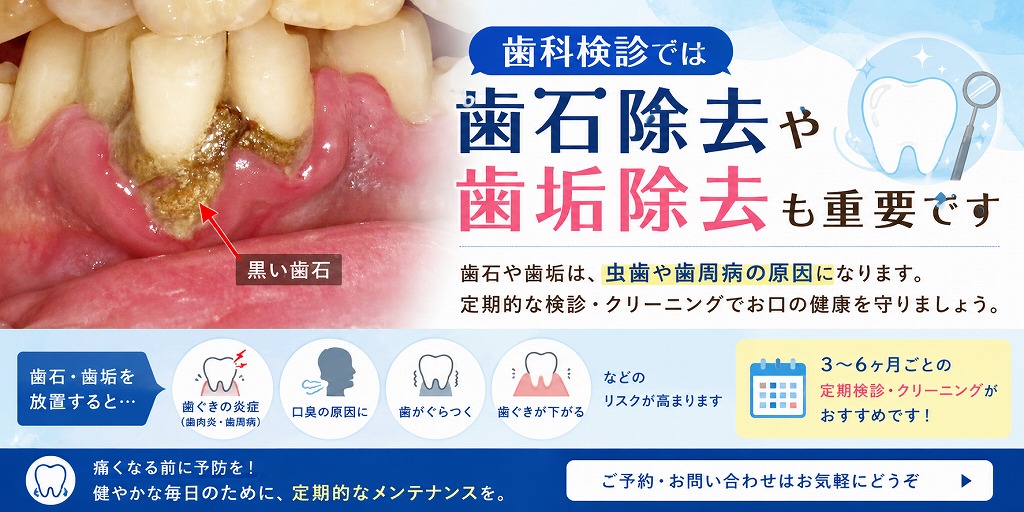 歯科検診では歯石除去や歯垢除去も重要です
