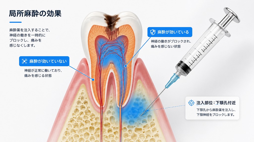 浸潤麻酔とは？その定義と作用機序