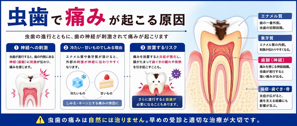 虫歯で痛みが起こる原因