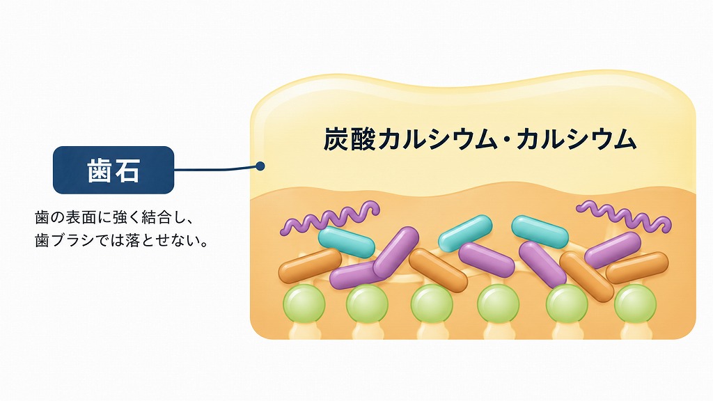歯垢が石灰化して歯石になる