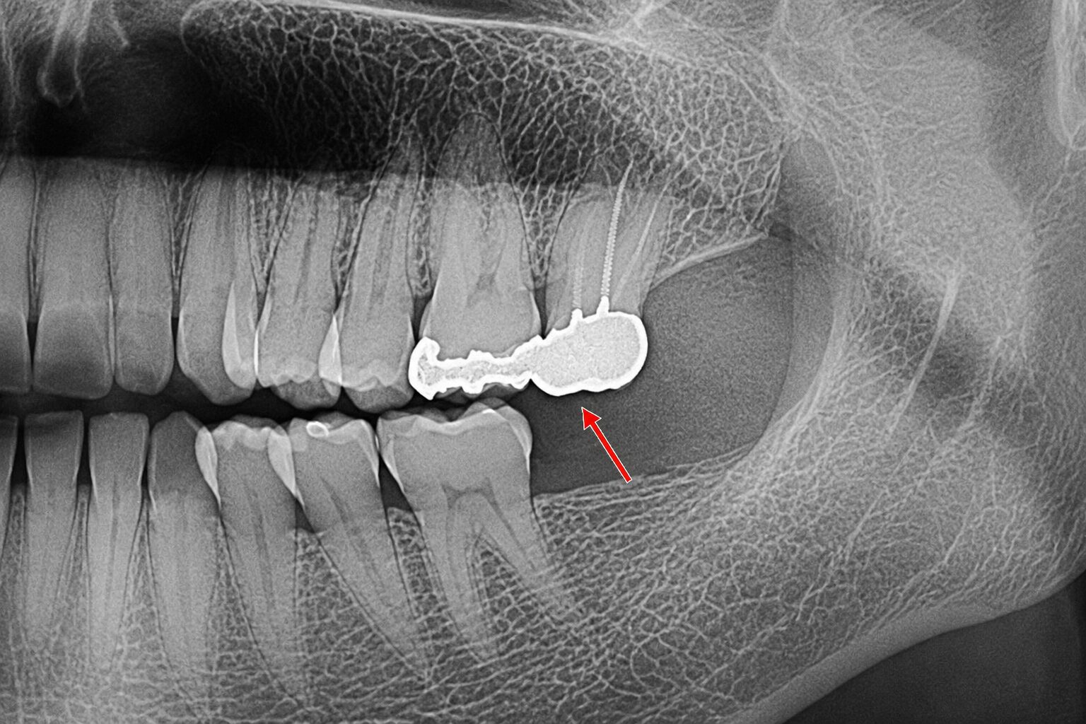 8番（親知らず）は抜歯、7番は根管治療＋クラウンで連結補強