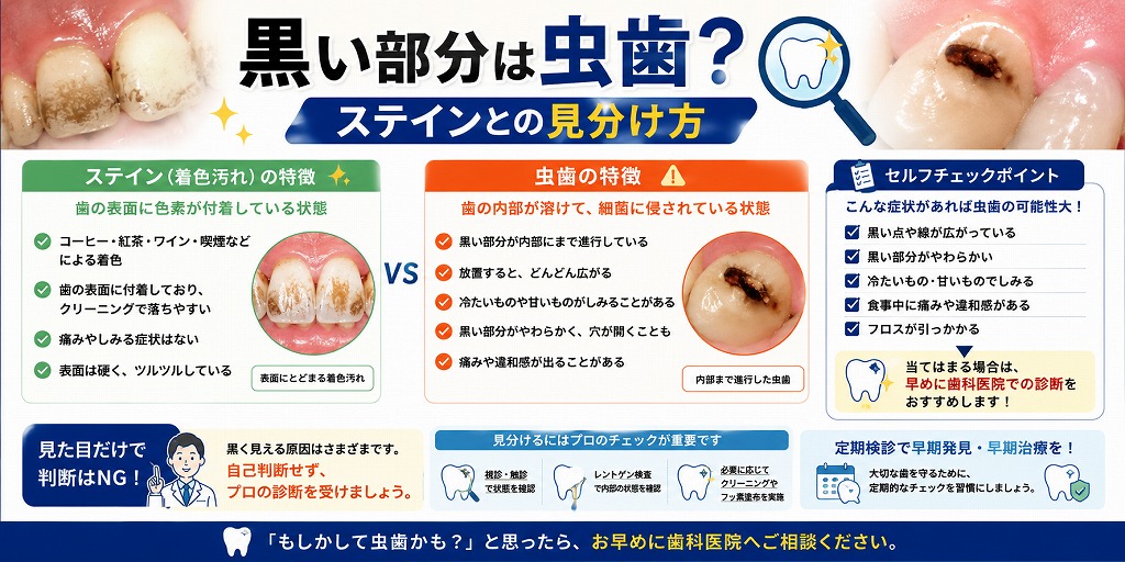 黒い部分は虫歯？ステインとの見分け方