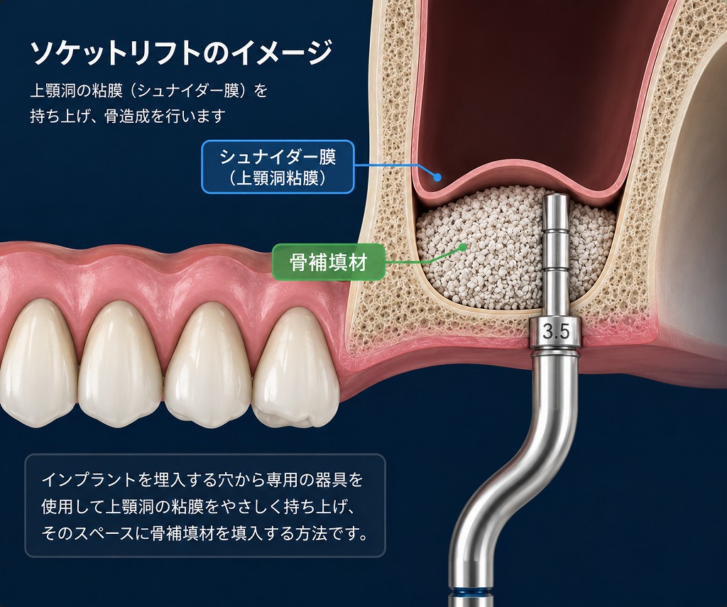 ソケットリフトとは？上顎の骨が足りなくてもインプラントが可能になる