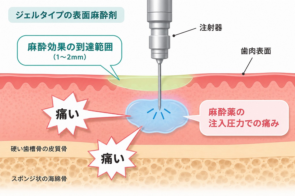 表面麻酔の麻酔到達範囲