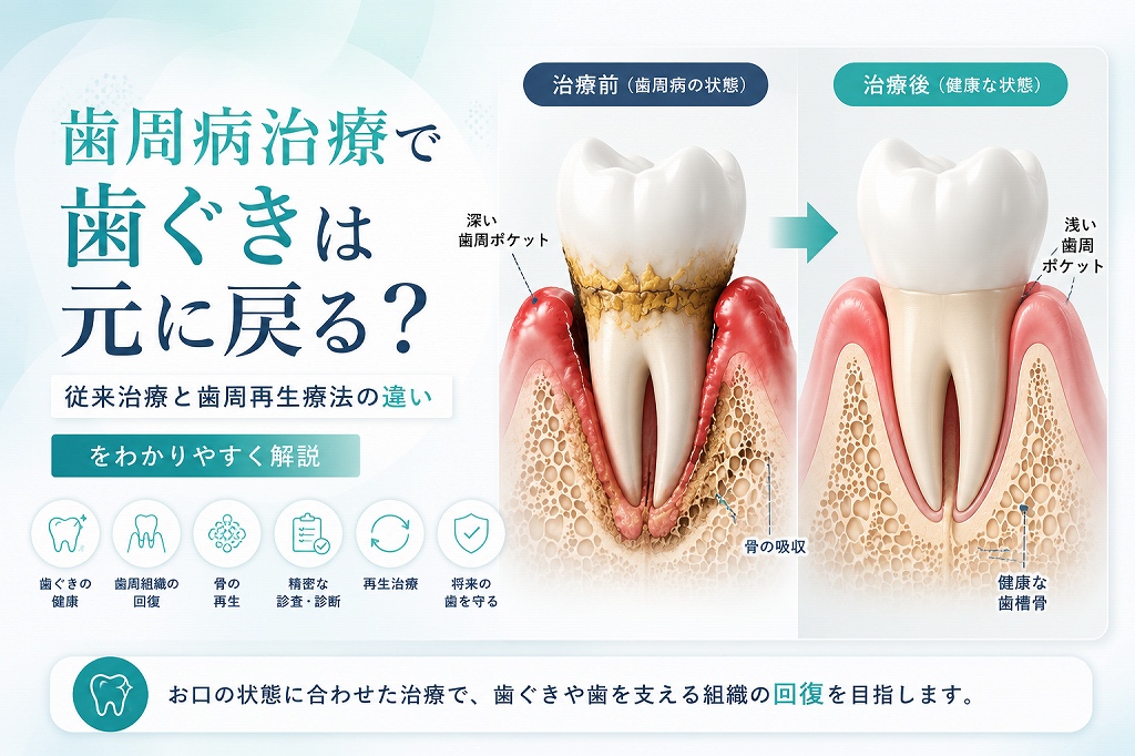 歯周病治療で歯ぐきは元に戻る？従来治療と歯周再生療法の違いをわかり
