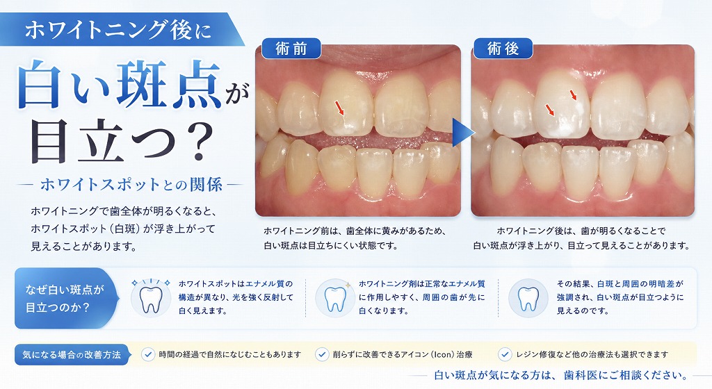 ホワイトニング後に白い斑点が目立つ？ホワイトスポットとの関係
