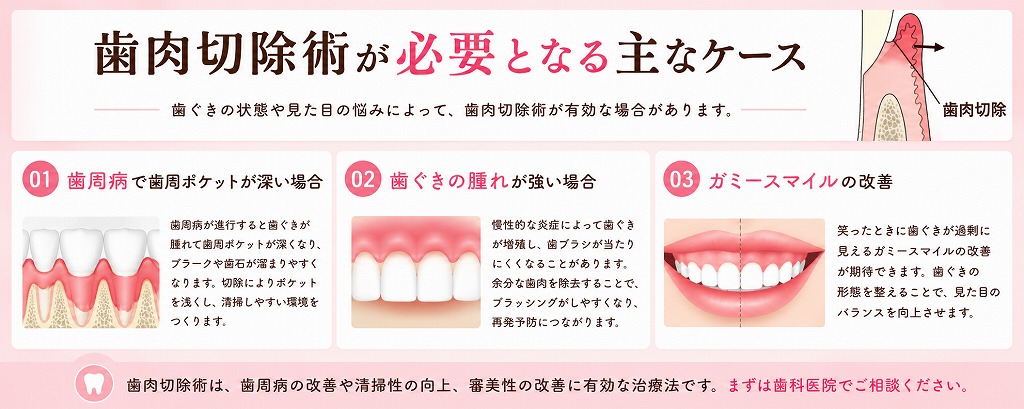 歯肉切除術が必要となる主なケース