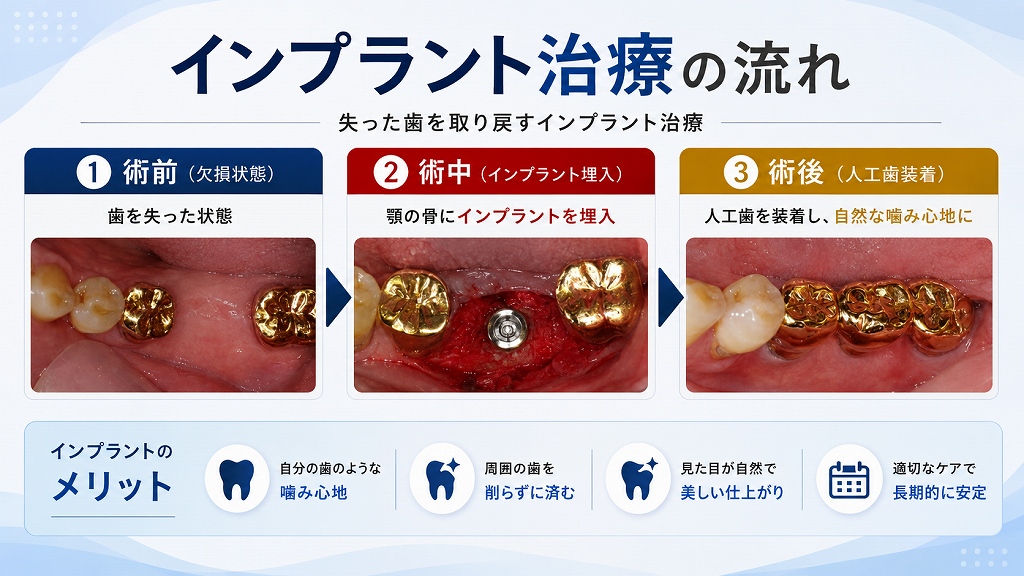 インプラント治療の流れ：術前・術中・術後