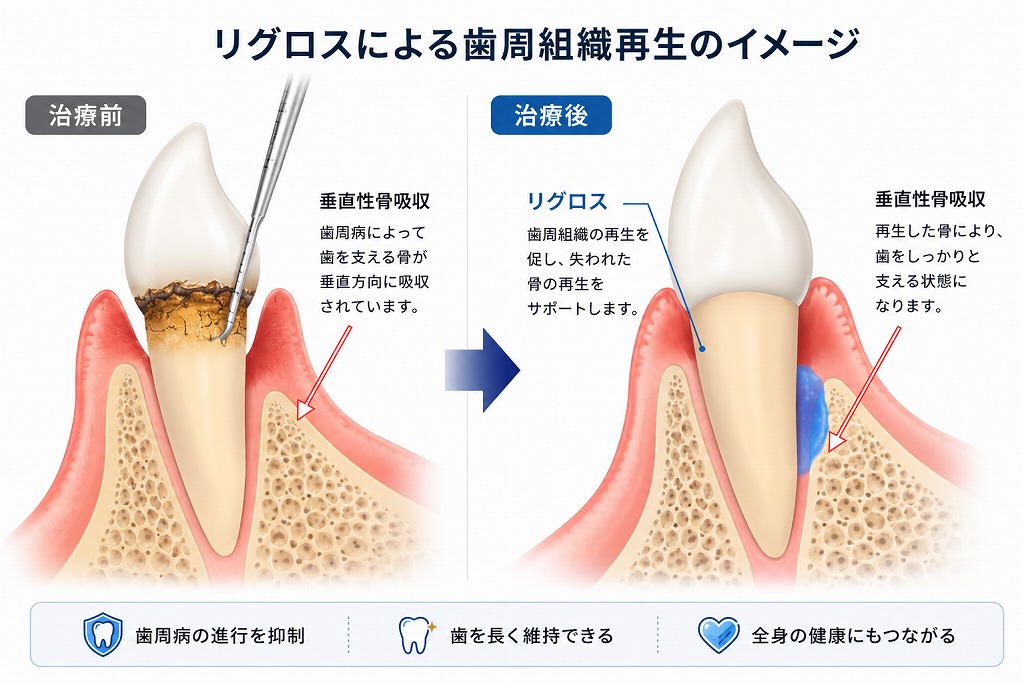 リグロス法