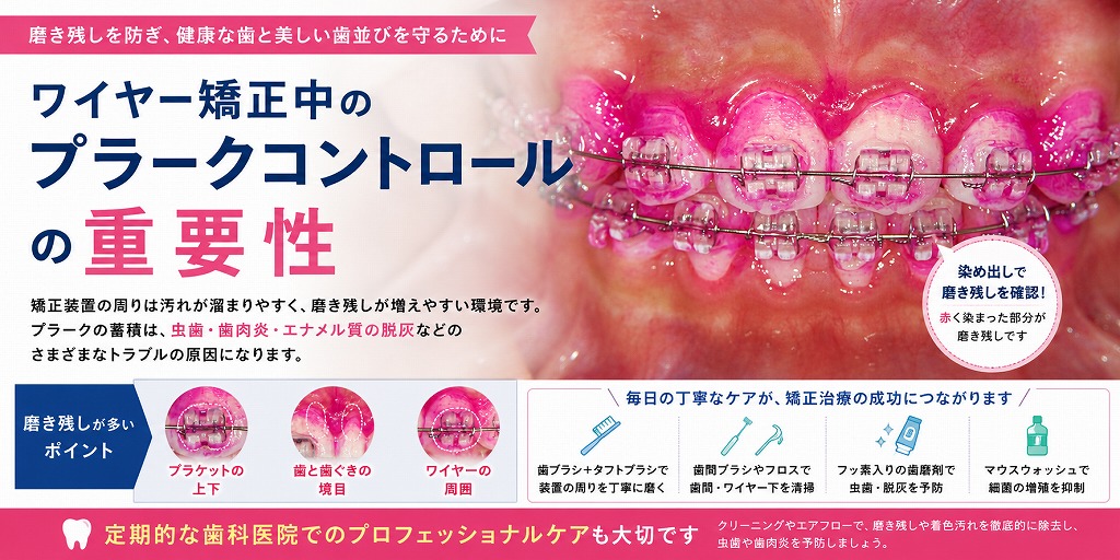 ワイヤー矯正中のプラークコントロールの重要性