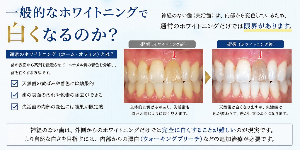 一般的なホワイトニングで白くなるのか?
