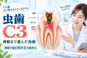 虫歯C3とは?神経まで進んだ虫歯の症状・治療法・歯を残せる可能性