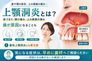 上顎洞炎とは？｜上の奥歯が痛い・頬が重い原因と歯性上顎洞炎の治療