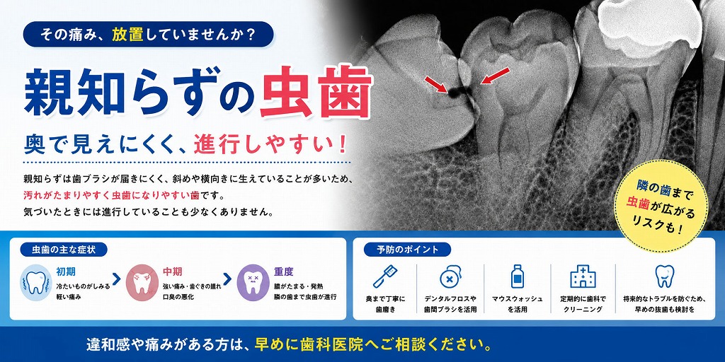 親知らずの虫歯とは？放置が危険な理由と治療法