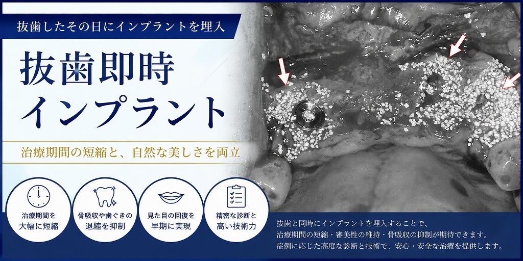 抜歯即時インプラント
