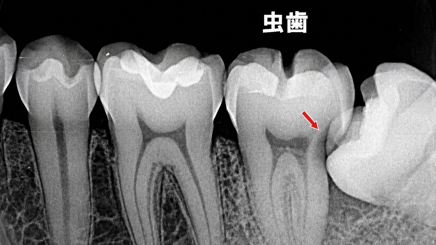 押されてできた虫歯も、噛んだ時の痛みの原因に。