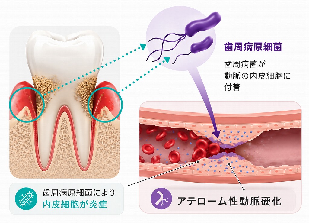 歯周ポケット内の細菌や炎症性物質が血管内へ流入し、動脈硬化を起こす