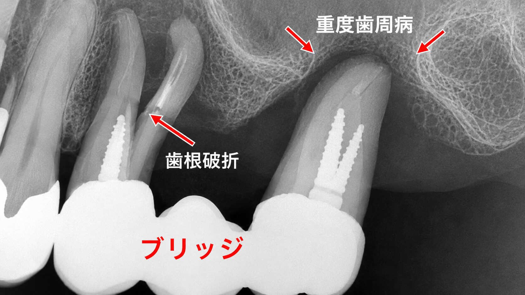 歯周病によるグラつきと歯根破折のX線所見