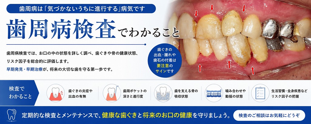歯周病検査でわかること