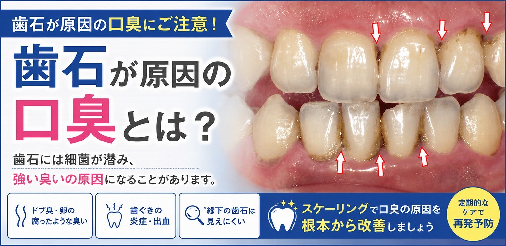 歯石が臭い原因？