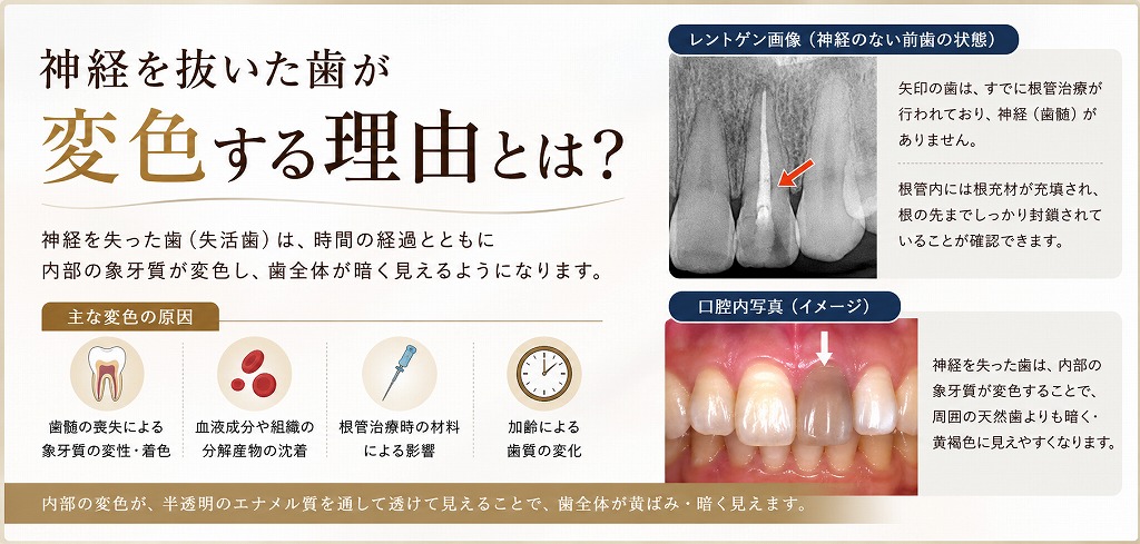 神経を抜いた歯が変色する理由とは?