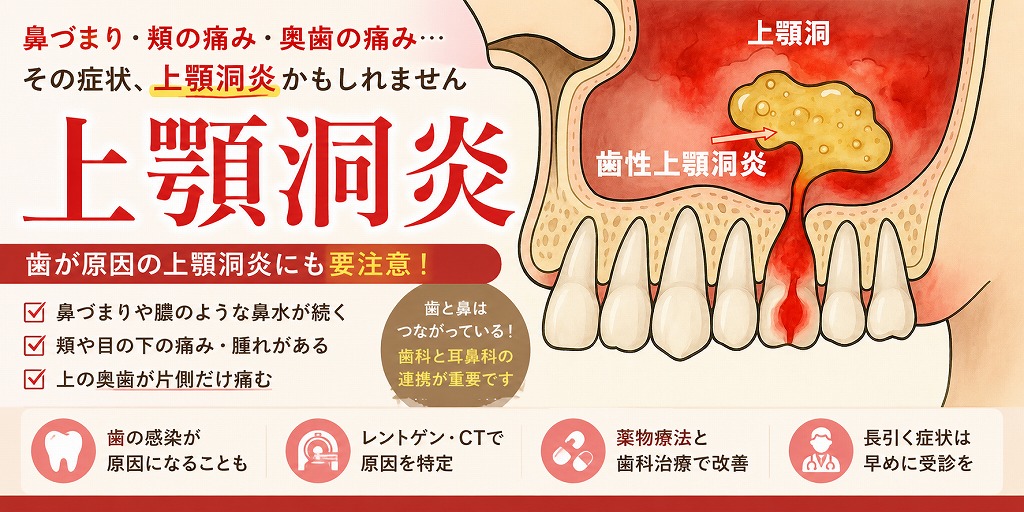 上顎洞炎とは？