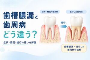 歯槽膿漏と歯周病の違いとは？｜症状・原因と歯肉炎との違いを解説