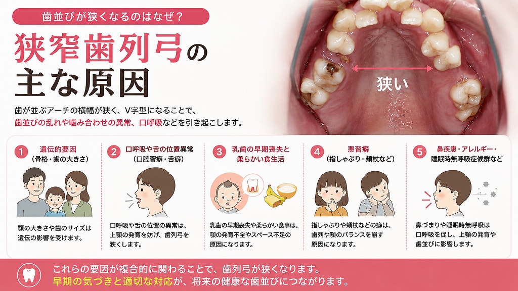 狭窄歯列弓の主な原因