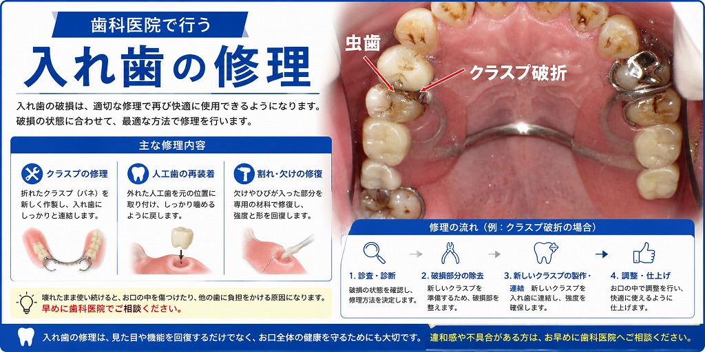 歯科医院で行う入れ歯の修理