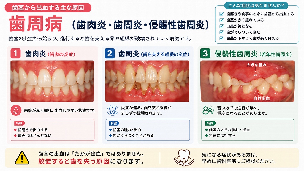 歯周病（歯肉炎・歯周炎・侵襲性歯周炎）