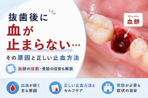 抜歯後に血が止まらないのは大丈夫?|正しい止血方法・血餅・受診の目安