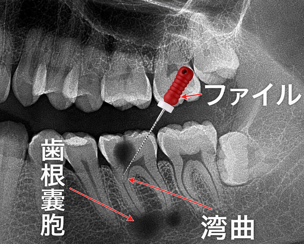 湾曲根管の根管治療は難しい