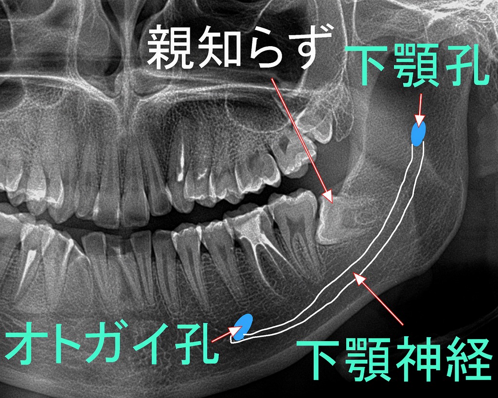 親知らずの抜歯