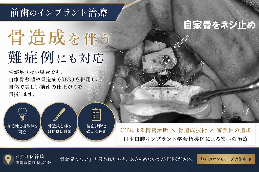 前歯のインプラント治療｜骨造成を伴う難症例の治療プロセスを歯科医が解説